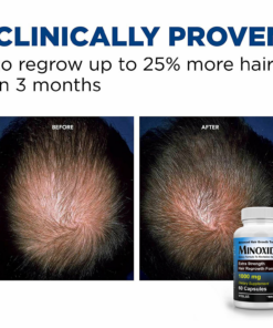 minoxidil 1000mg tabletas para crecimiento de cabello4